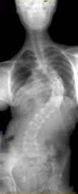 spine x-ray before treatment