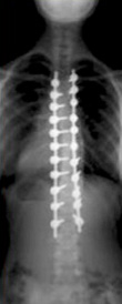 spine x-ray after treatment