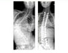 Correction of Scoliosis in Cerebral Palsy - 1