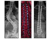 Adolescent Idiopathic Scoliosis - 6