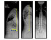 Adult Deformity Correction - 1