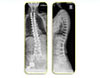 Adult Deformity Correction - 2