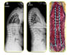 Adult Deformity Correction - 3