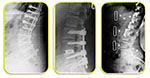 Adult Deformity Correction - 4