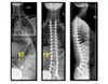 Cerebral Palsy - 1
