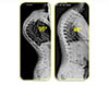 Correction of Scheuermann’s Kyphosis - 1