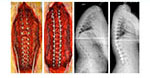 Correction of Scheuermann’s Kyphosis - 2