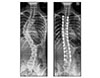 Costoplasty - 1