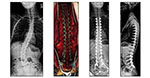 Neuromuscular Duchene Muscular Dystrophy - 2