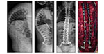 Posterior Vertebral Column Resection (PVCR) - 1