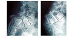 Reduction of High Grade Spondylolisthesis - 1