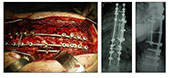 Anterior Scoliosis Correction - 1